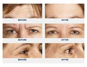 Anti-Ageing | Nayandeep Eye Hospital