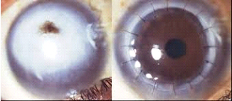 Cornea | Nayandeep Eye Hospital