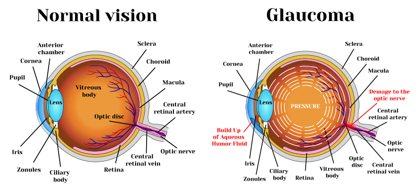 Glaucoma | Nayandeep Eye Hospital