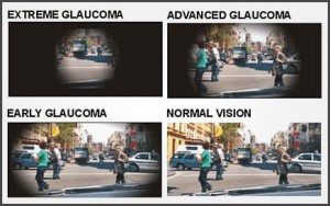 Glaucoma | Nayandeep Eye Hospital