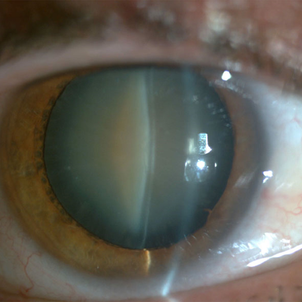 cataract